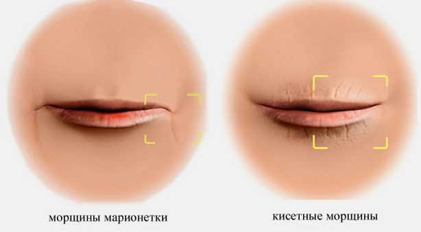 Как убрать морщины вокруг губ: способы избавиться от кисетных морщин в домашних услових, с помощью косметологии и пластической хирургии