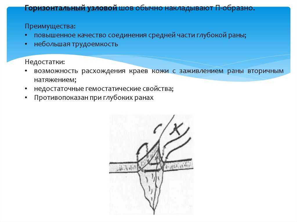 Разошелся внутренний шов после операции что делать. чем грозит расхождение швов. частичное расхождение шва