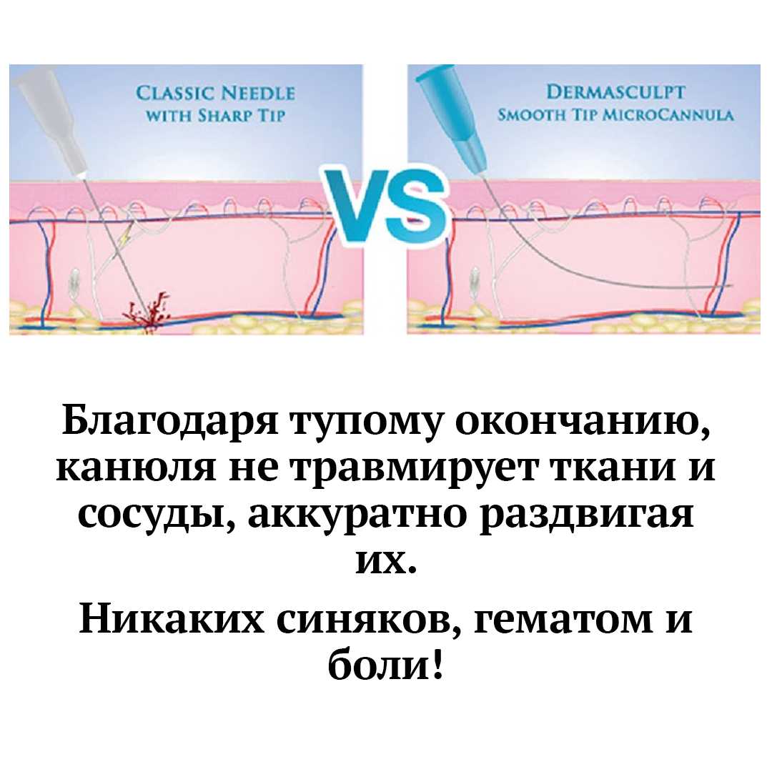 Сравнение: иглы и канюли для контурной пластики