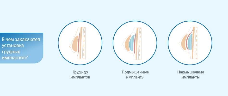 Риски и осложнения при увеличении груди