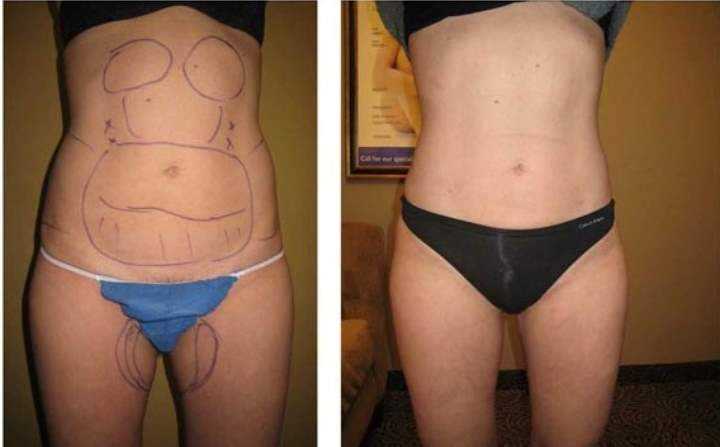 Липосакция body jet: новая методика липосакции