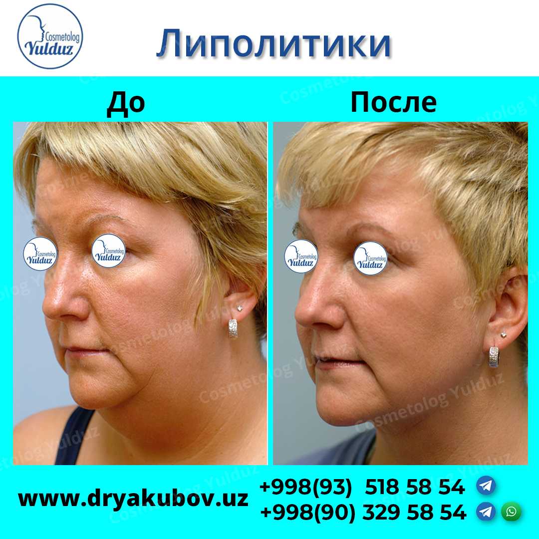 Что такое липолитики и зачем их использовать | 1с:салон красоты