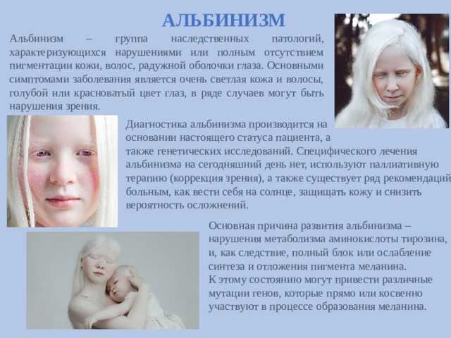 Альбинизм у человека