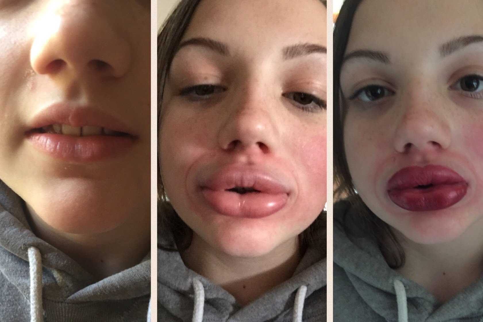 Как сделать губы пухлыми: 8 способов увеличить губы