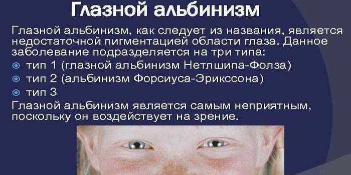 Люди-альбиносы: как выглядят и где живут, опасен ли альбинизм?