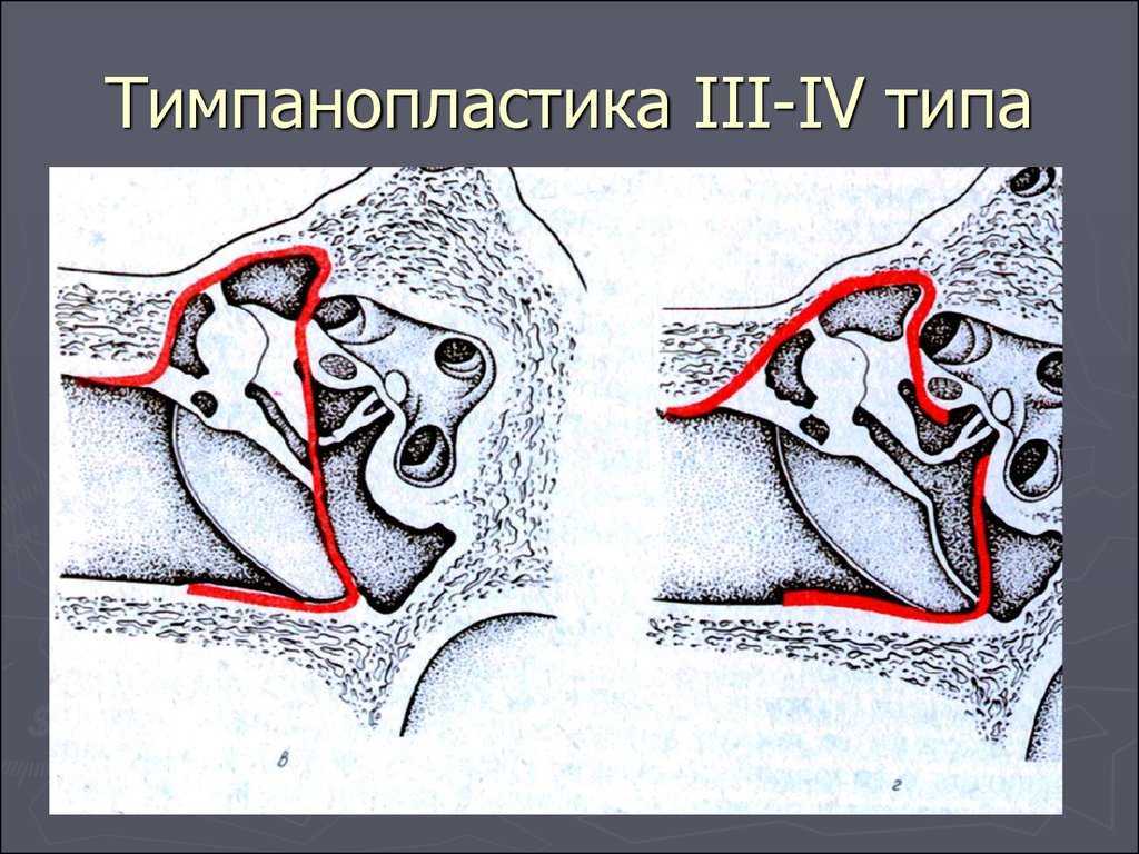 Тимпанопластика: что это такое, как делается