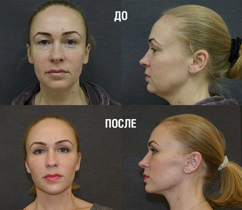 Подтяжка лба и бровей - фронтлифтинг и броулифтинг