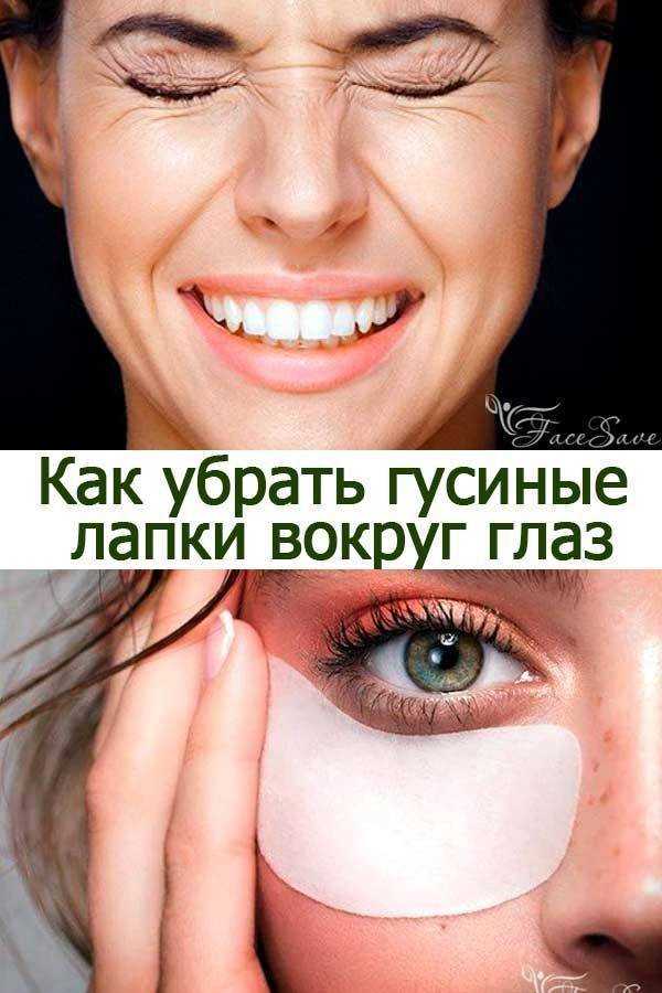 Гусиные лапки вокруг глаз: как избавиться раз и навсегда