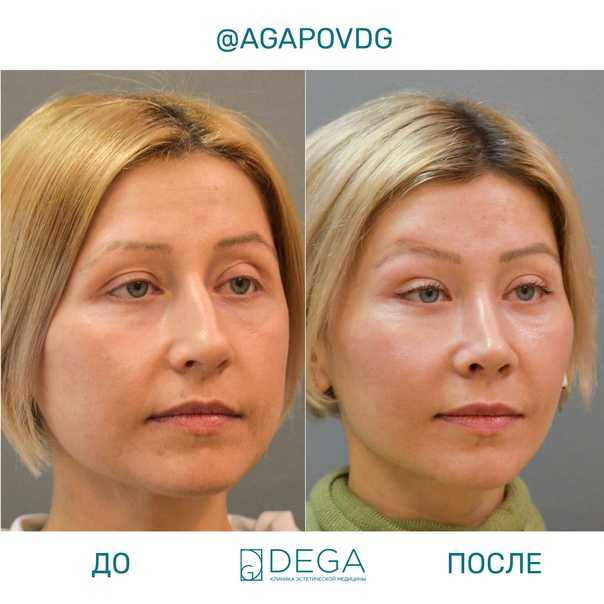 Увеличение губ гиалуроновой кислотой: виды и преимущества