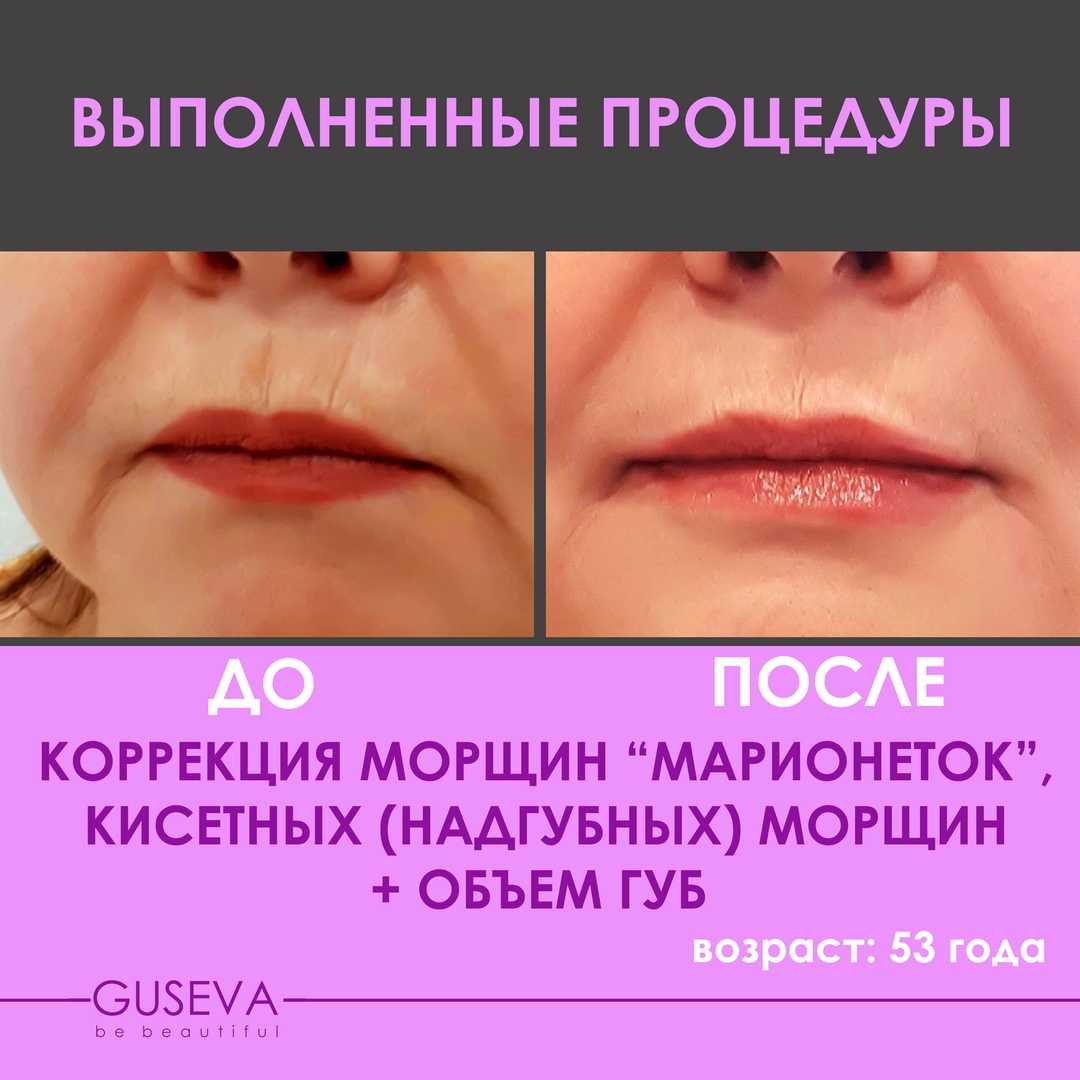 Морщины-марионетки: как убрать