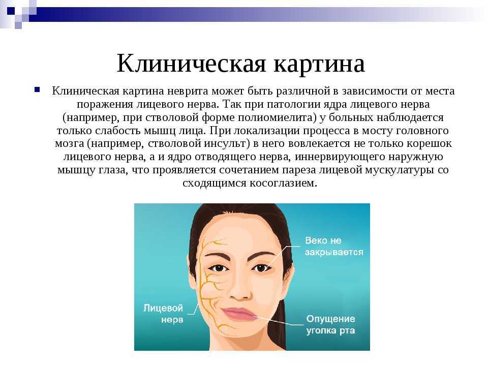 Неврит лицевого нерва: симптомы и лечение