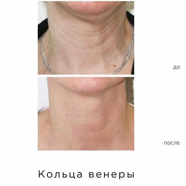 Кольца венеры: почему появляются, как убрать морщины и складки на шее у подростков и взрослых / mama66.ru