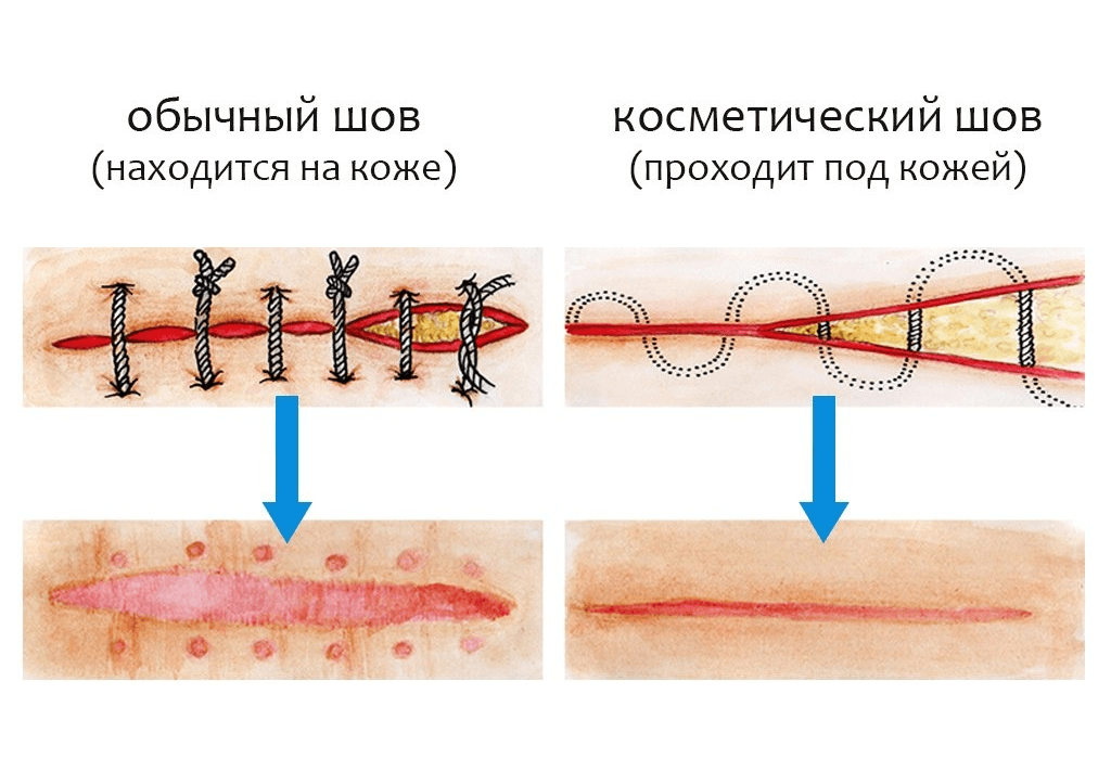 Как бы это странно ни прозвучало, но с такой ситуацией, как разошедшийся после оперативного вмешательства шов, столкнуться все-таки можно Рассказываем, что делать