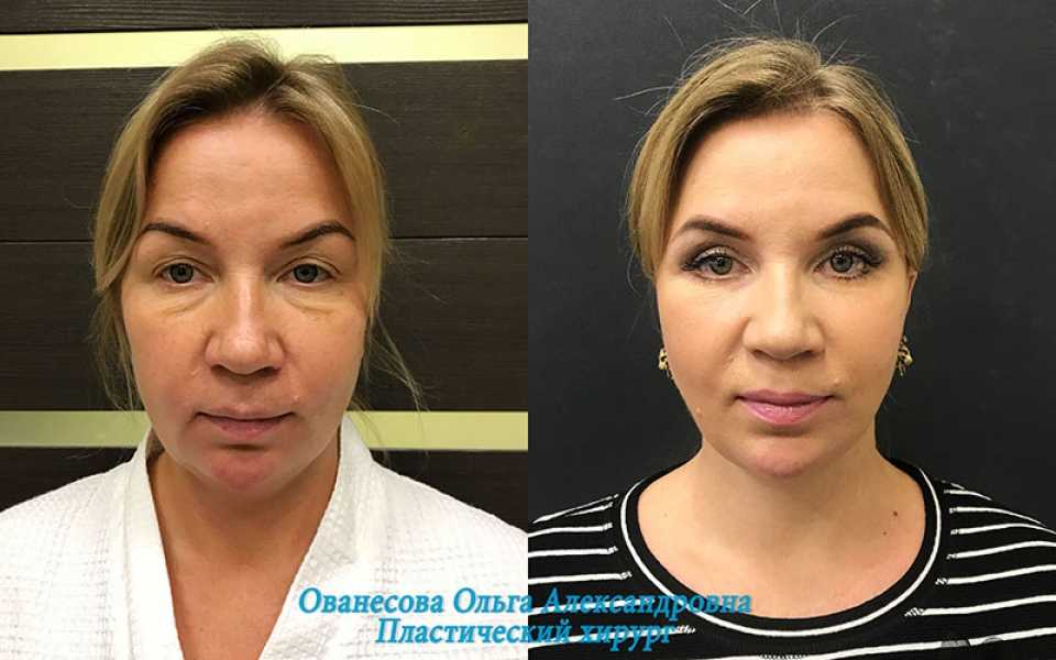 Что такое малярные мешки на скулах, или суфы | za-rozhdenie.ru