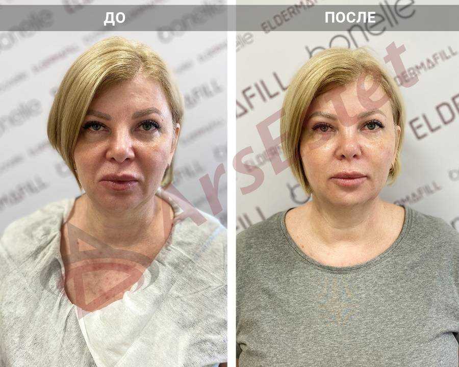 Мезоботокс: новые возможности самого популярного в мире препарата!