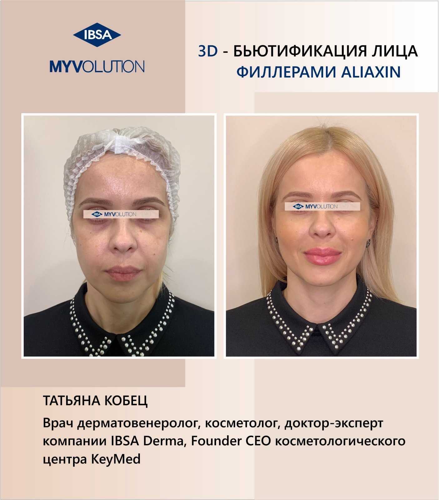 Парижская техника увеличения губ: особенности проведения, знаменитости до и после увеличения губ бантиком | marykay-4u.ru