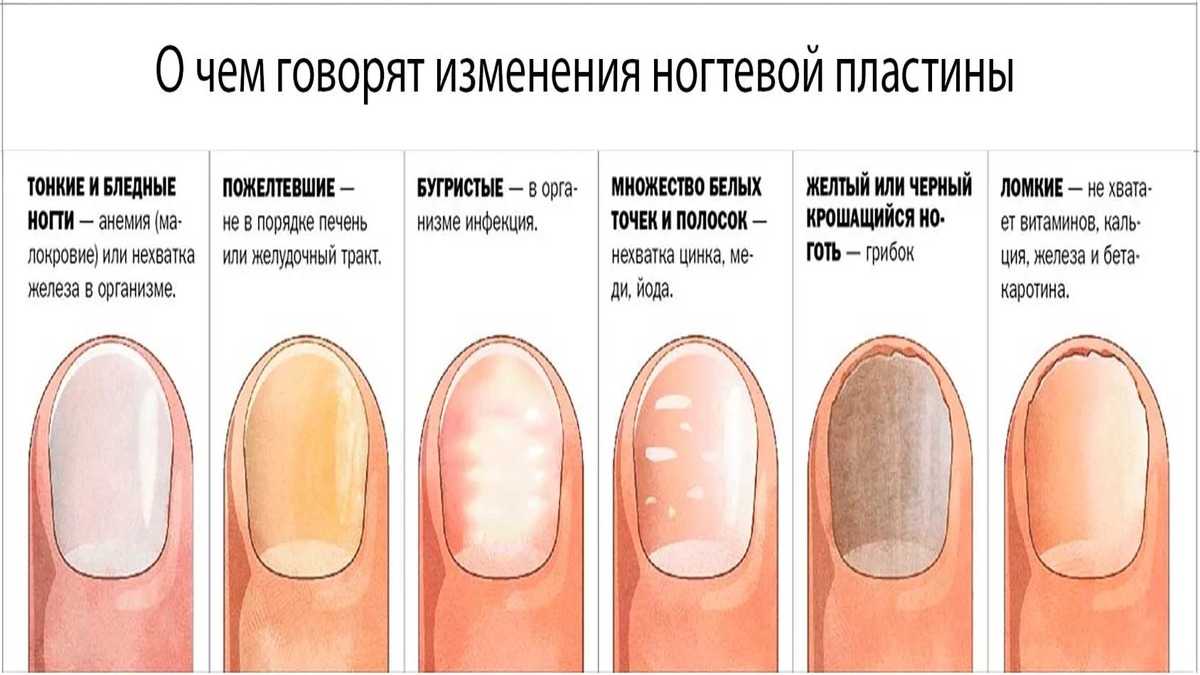 Гипонихий ногтя: причины и лечение
