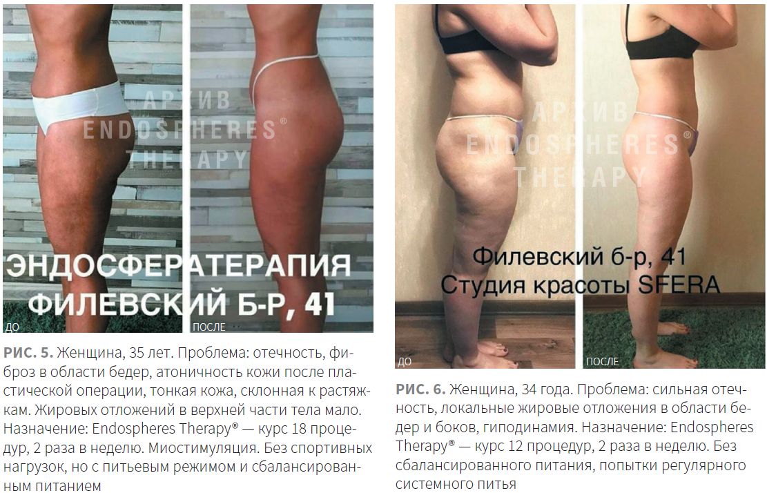 Эндосфера-терапия®когда работа над фигурой — удовольствие!