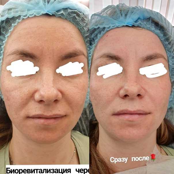 Малярные мешки на скулах, или суфы