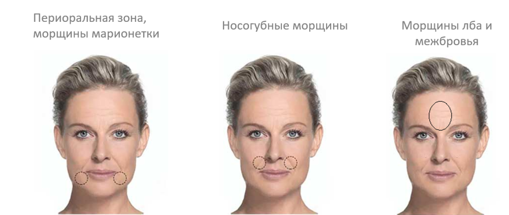 Как убрать брыли и морщины марионетки в домашних условиях - женщина без предела