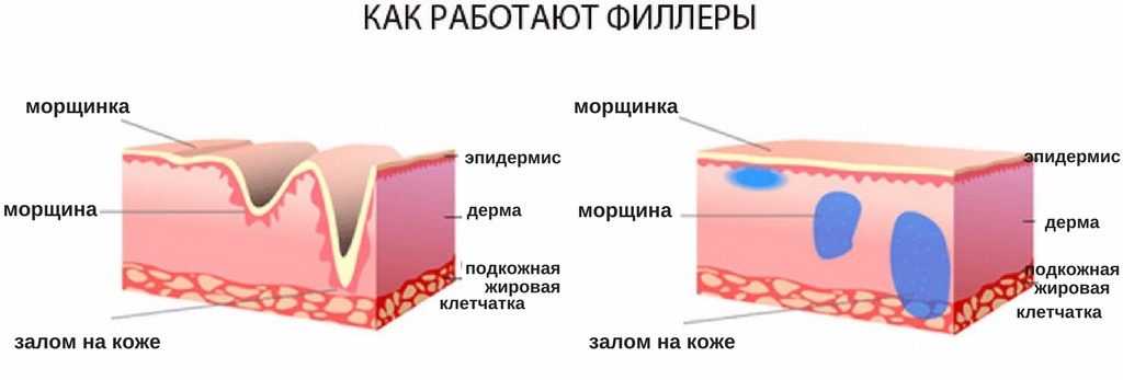 Осложнение после ковид-19: фиброз легких