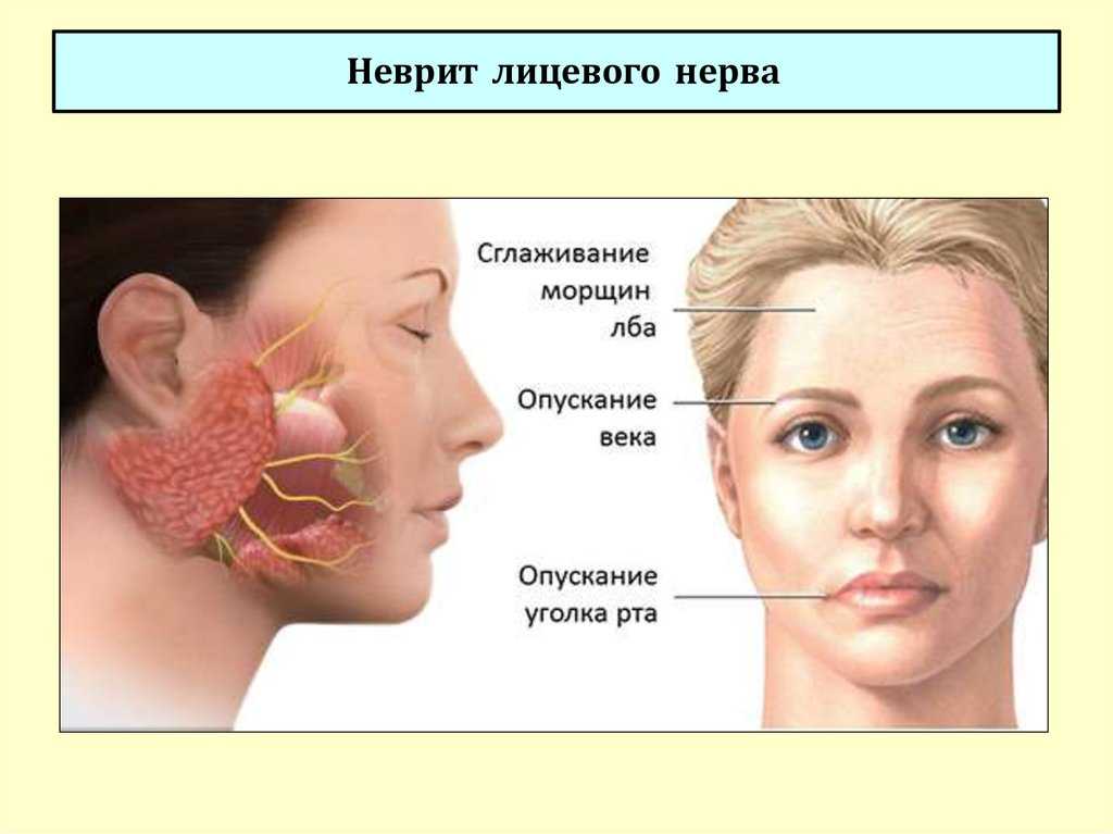 Фарматека » невропатия лицевого нерва