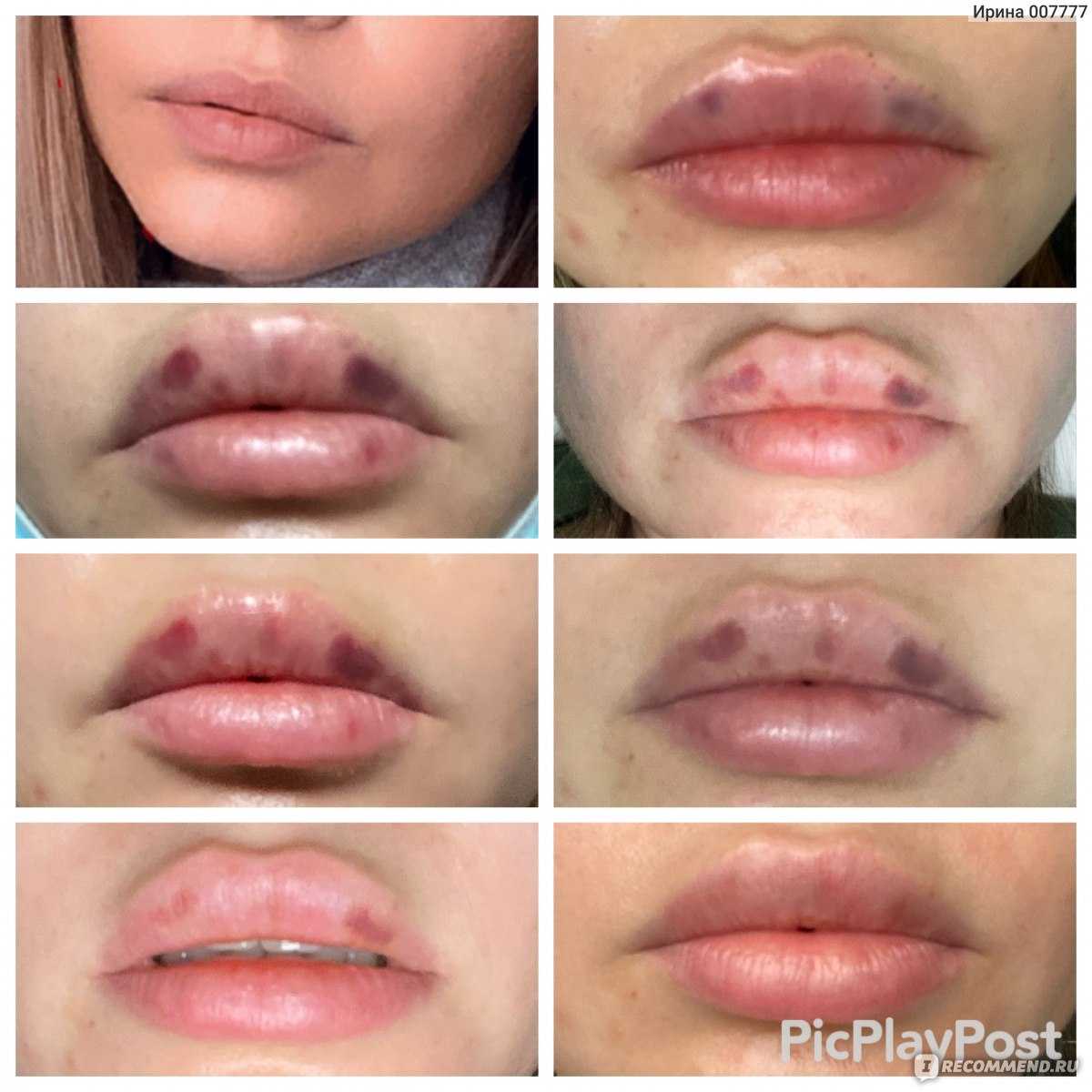 Guide to lip flips lip filler alternative | rejuva center