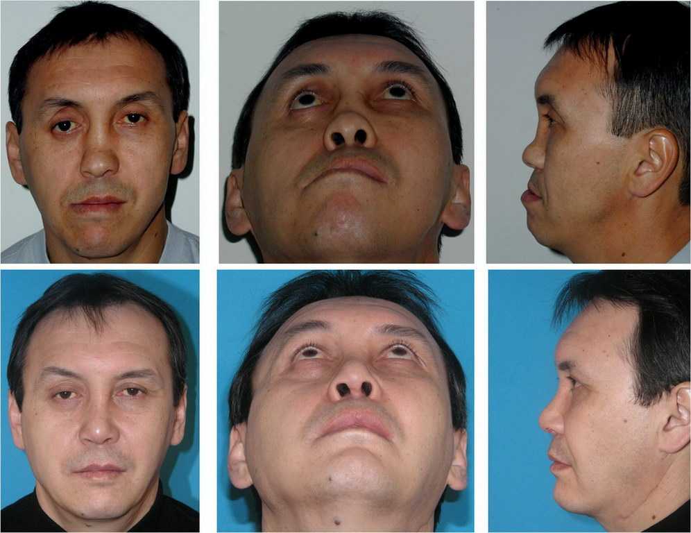 Деформация ушных раковин – врожденная и приобретенная, отопластика