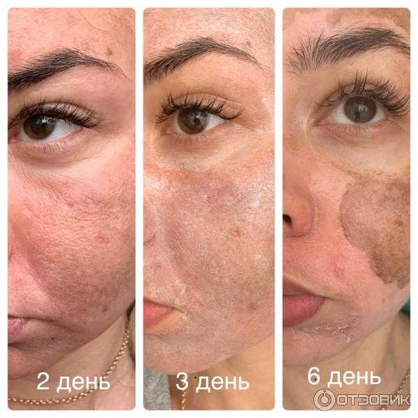 Реабилитация после лазерной шлифовки: этапы заживления по дням, ограничения и уход за кожей после лазерной шлифовки