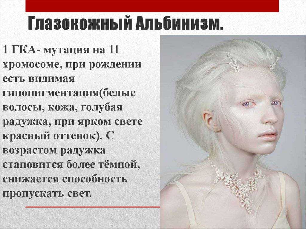 Альбинос: кто такой, 3 типа альбинизма, способы лечения, советы, видео