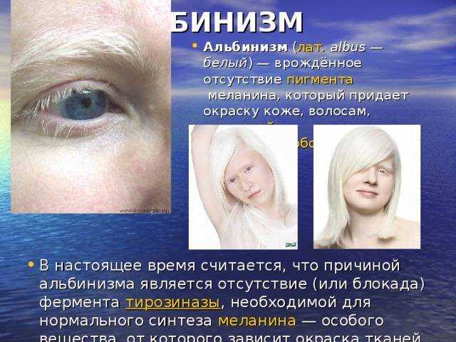 Люди альбиносы: факты, известные модели-альбиносы
