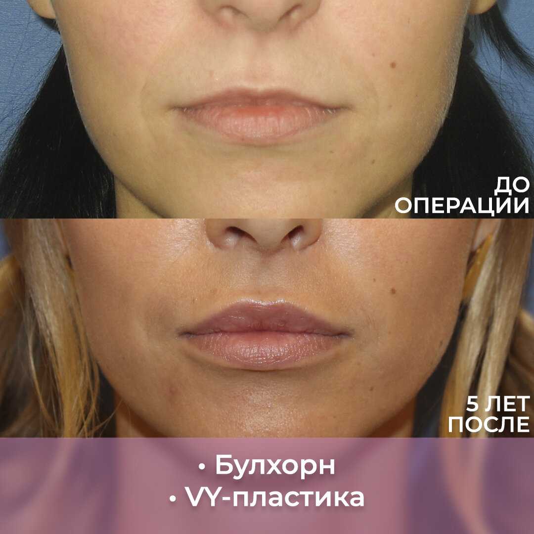 Липофилинг лица - что это такое, описание процедуры | клиника эстетической медицины expert clinics