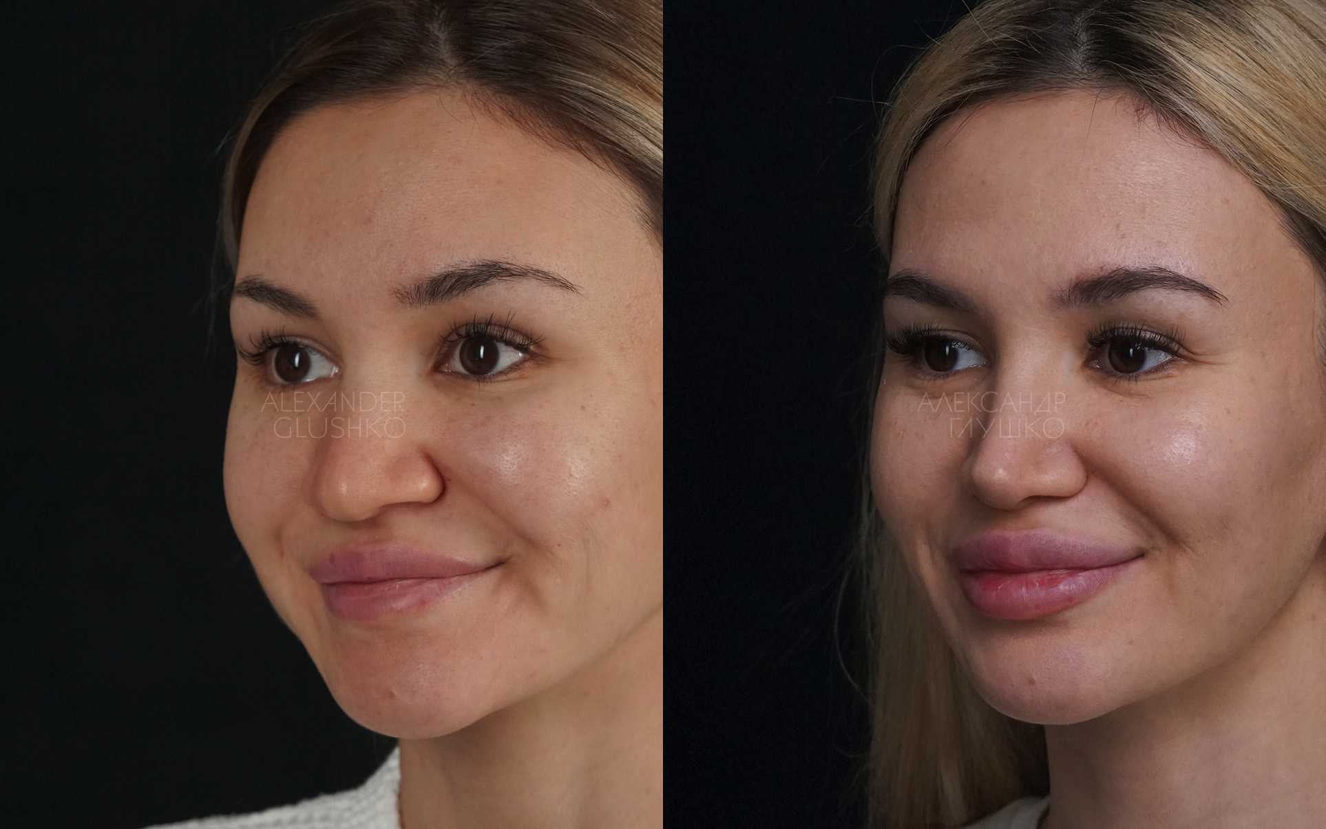 Техники массажа для изменения формы и размера носа
