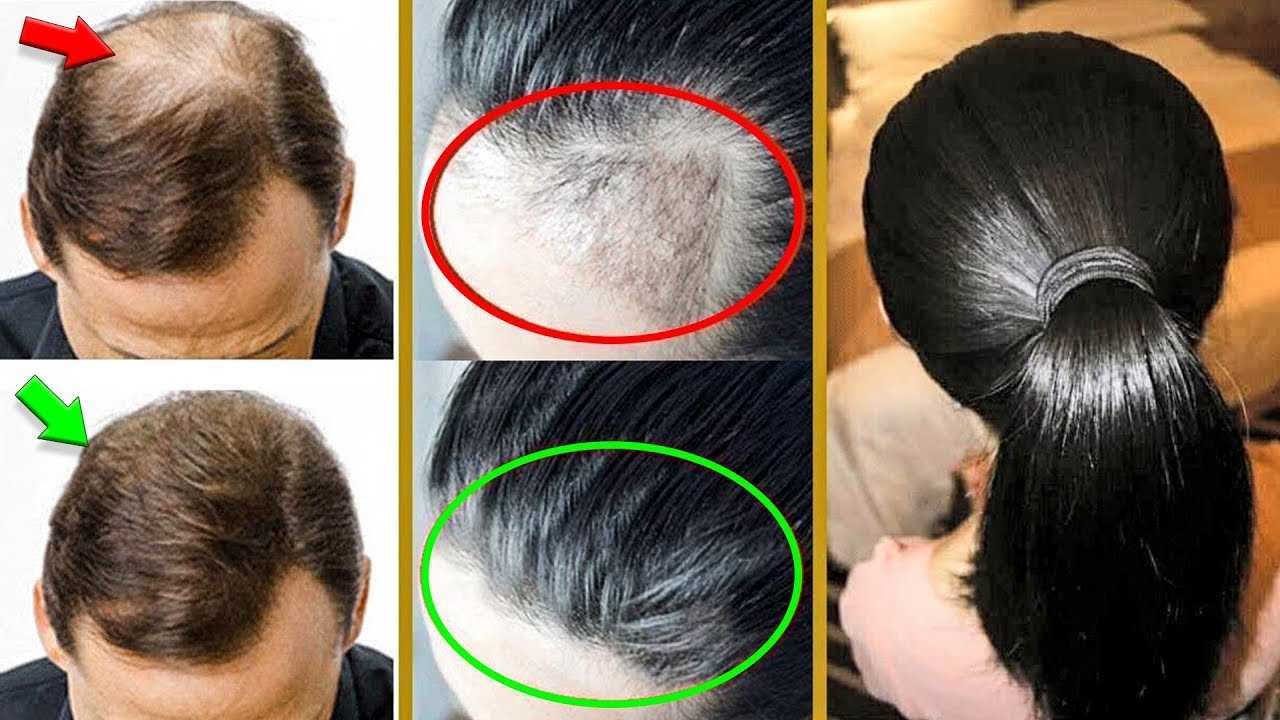 Какая стрижка подойдет лысеющему?