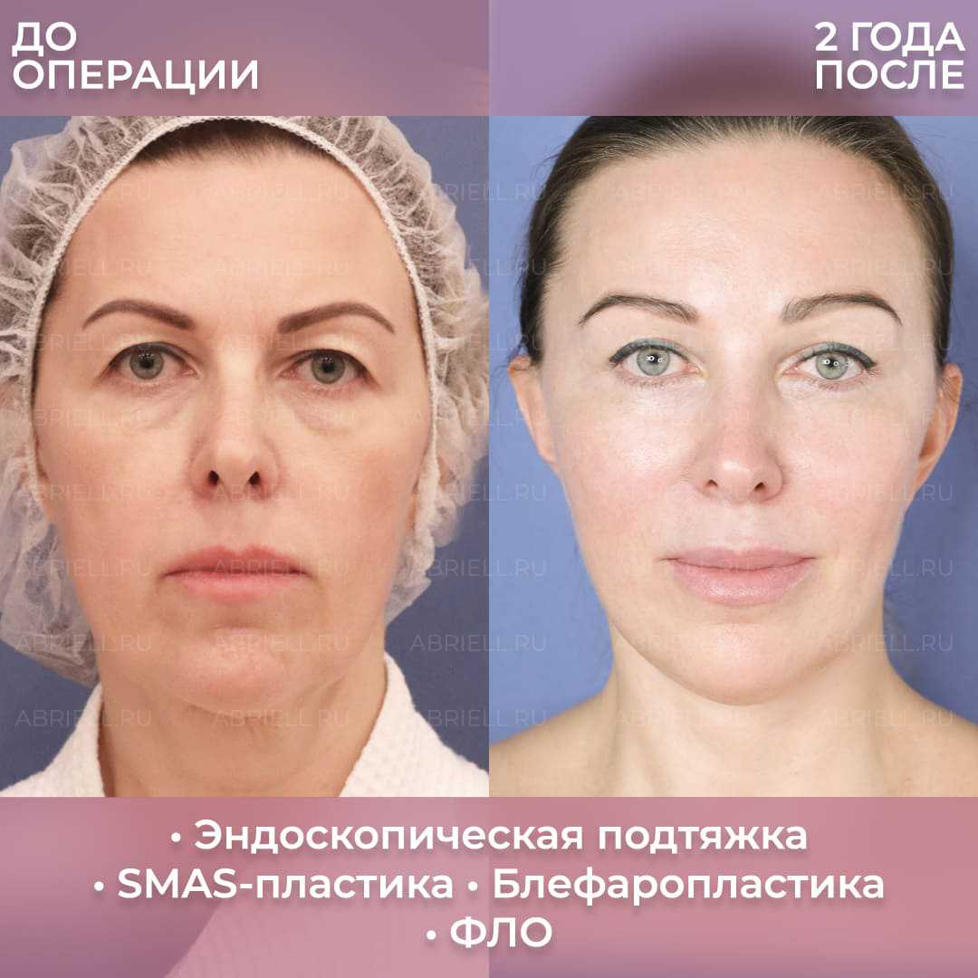 Эндоскопическая подтяжка лба — пластическая операция, которая позволяет малой кровью получить заметное омоложение верхней трети лица Разумеется, это все равно хирургическая операция, выполняемая в большинстве случаев под общим наркозом