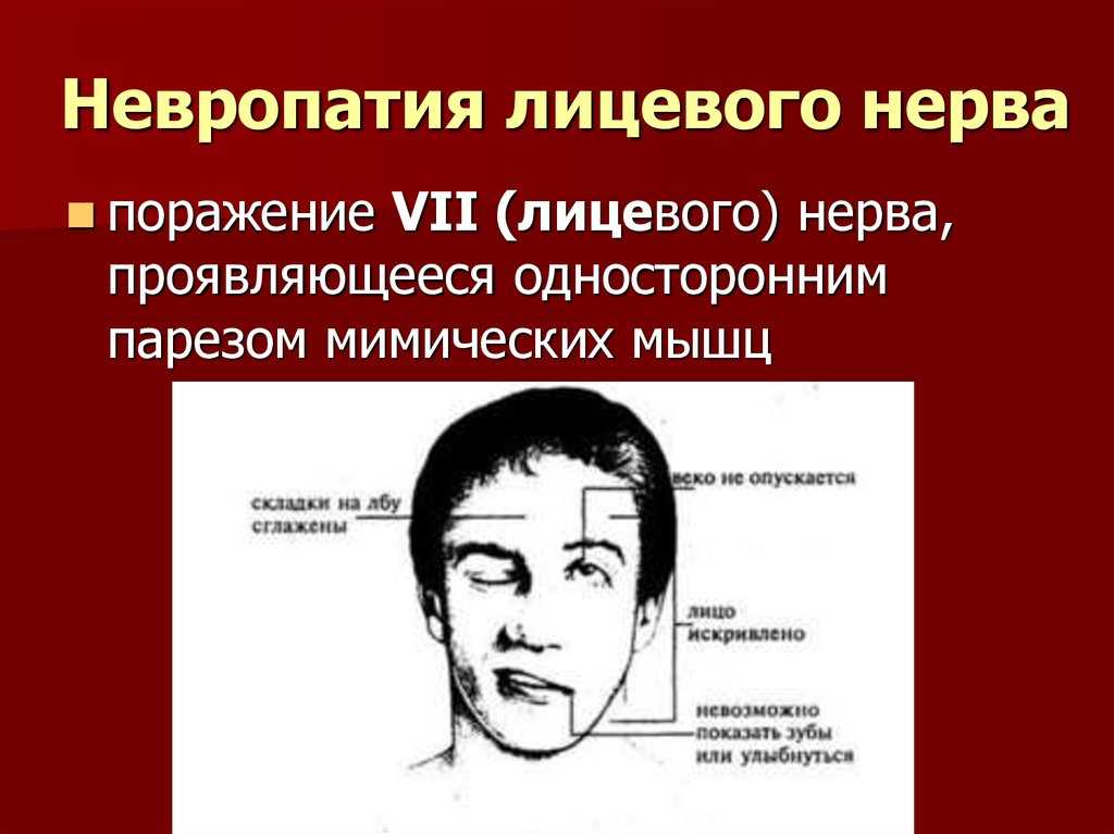 Неврит лицевого нерва / заболевания / клиника эксперт