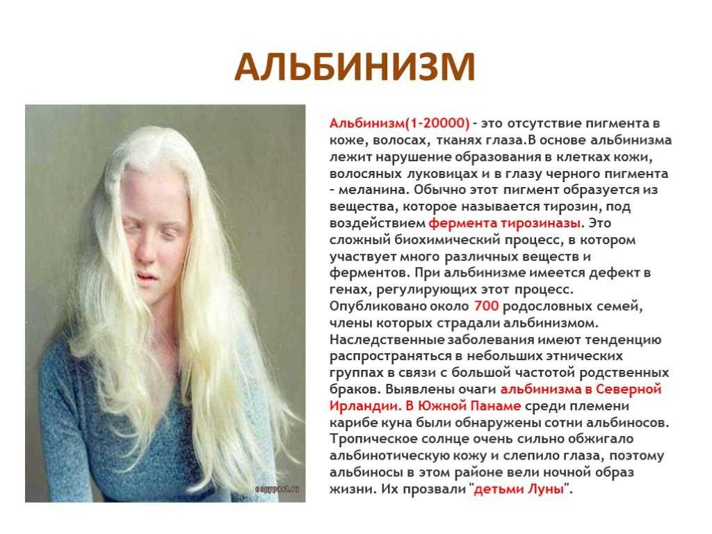 Люди альбиносы: цвет глаз, интересные фото и факты