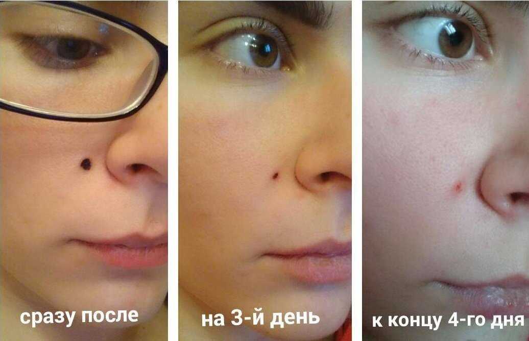 Как убрать рубцы и шрамы: подробно о способах удаления
