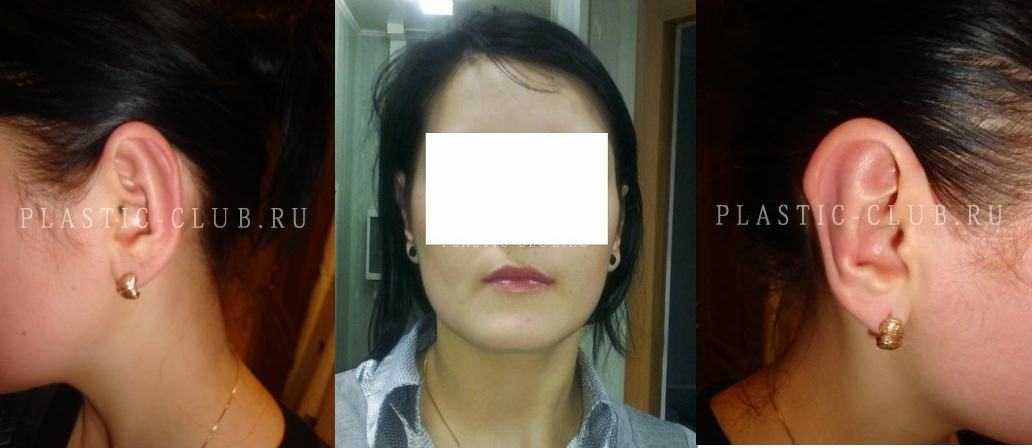 Отопластика: коррекция ушных раковин, устранение лопоухости