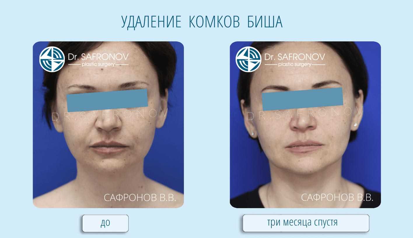 Комки биша: зачем знаменитости их удаляют?