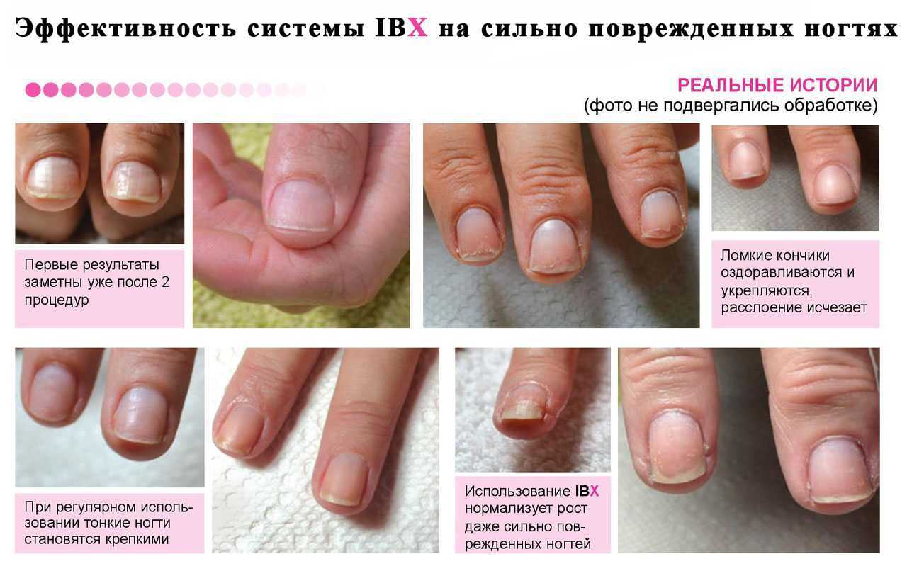 7 способов отбелить ногти в домашних условиях и избавиться от их желтизны