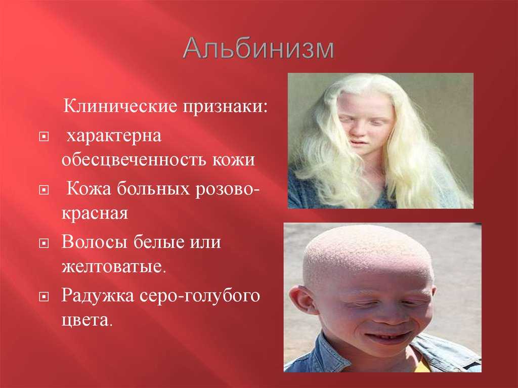Люди альбиносы - интересные факты и фото