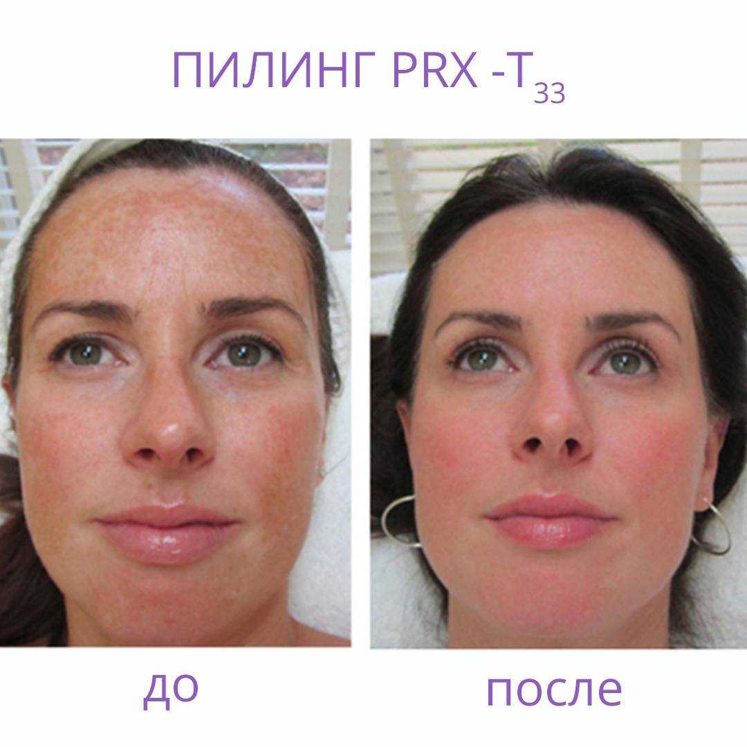 Химические пилинги для лица: виды, какие существует