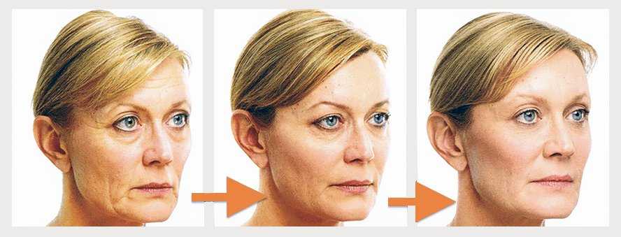 «fox eyes», «лисьи глазки» и «browlift». опасная процедура.
