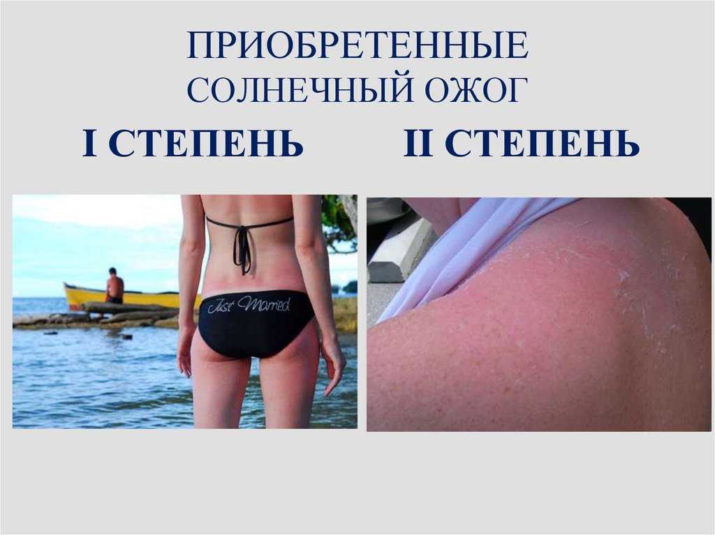 Что нельзя есть, пить и принимать, чтобы не обгореть на солнце, и как бороться с ожогами - фарммедпром