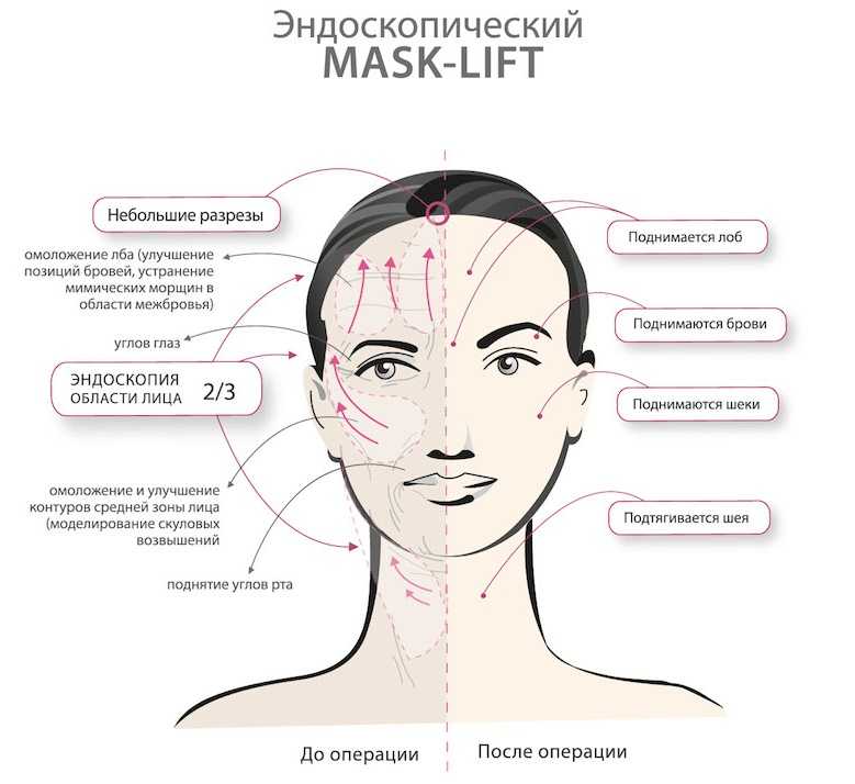Инъекционная контурная пластика