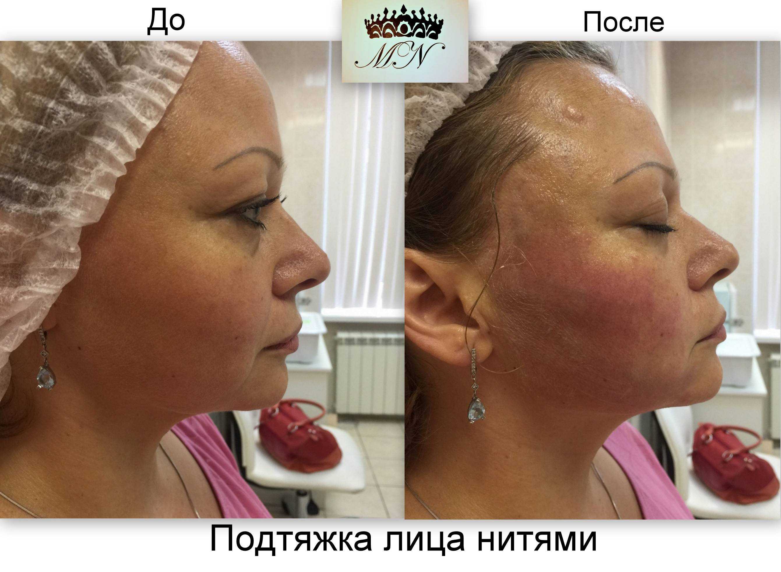 Мезонити или филлеры: сравнение методов омоложения