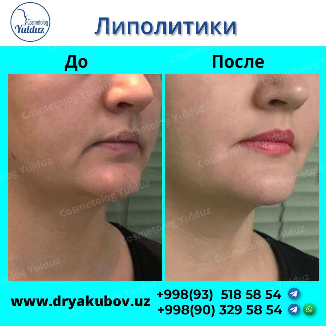 Аппаратные методы коррекции фигуры: как гибнут жировые клетки