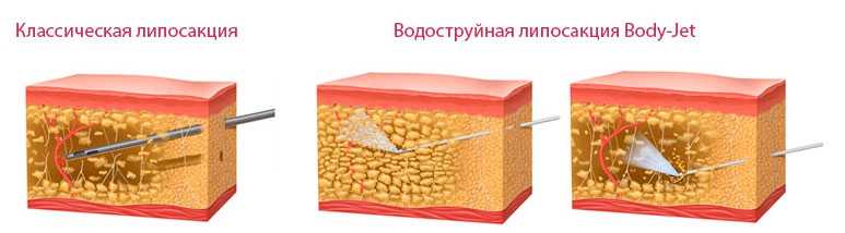 Липосакция ультразвуковая (кавитация) – уберите жир навсегда (2021)
