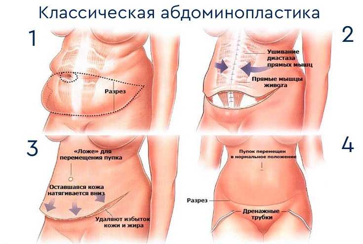 Абдоминопластика (пластика живота): показания, методы и проведение операции, результат и восстановление